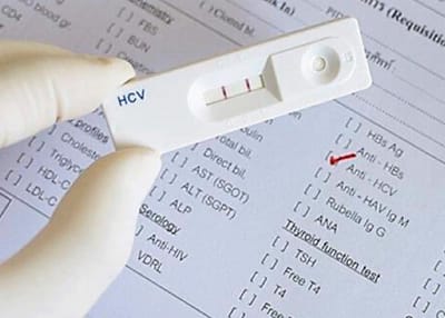 Rapid Hepatitis C Testing Helps Screen Young Adults