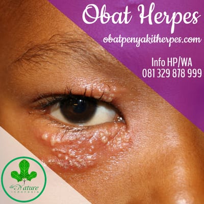 OBAT HERPES TRADISIONAL YANG AMPUH