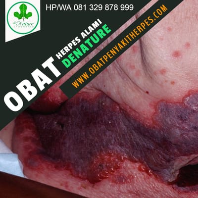 OBAT KARURAWIT TRADISIONAL