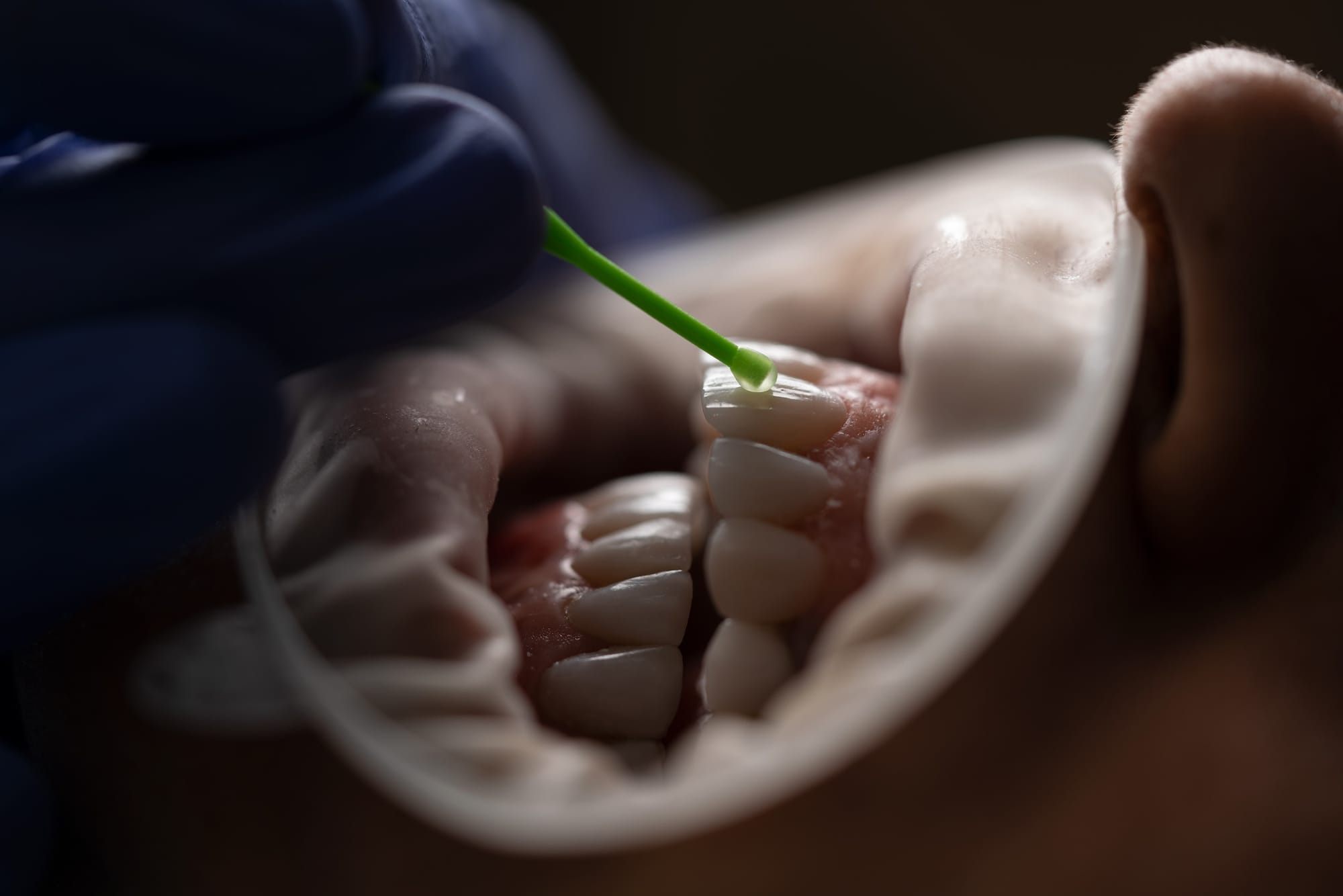 DIY Methods for Relieving Pain from Fractured Teeth
