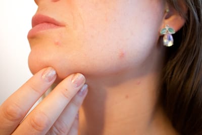 Why your skin is breaking out during lockdown?