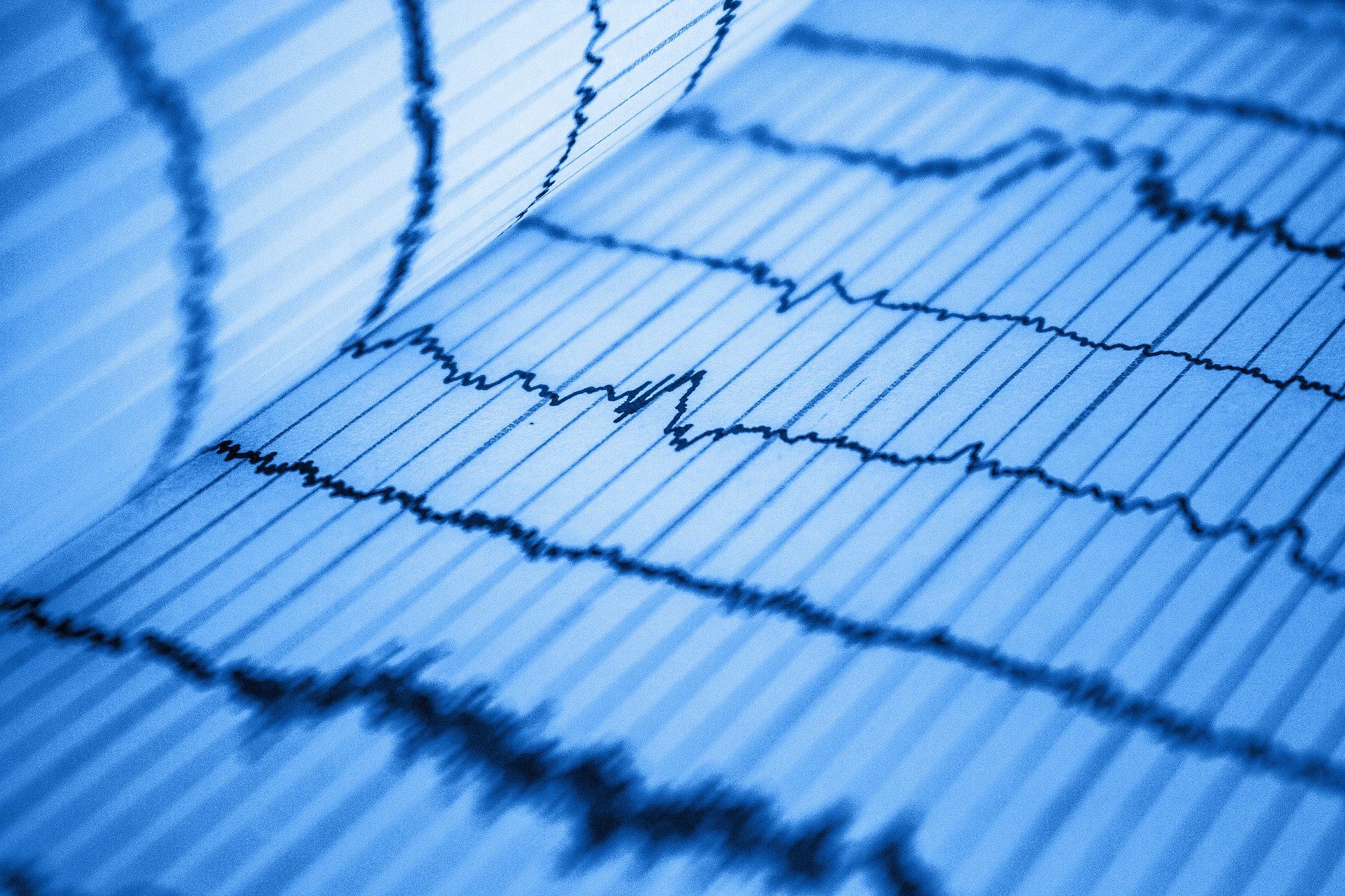 Électrocardiogramme (ECG)