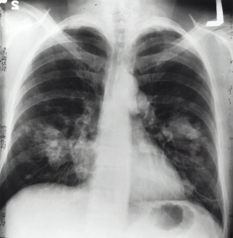 Early Detection of Lung Cancer Possible with Inhalable Sensors