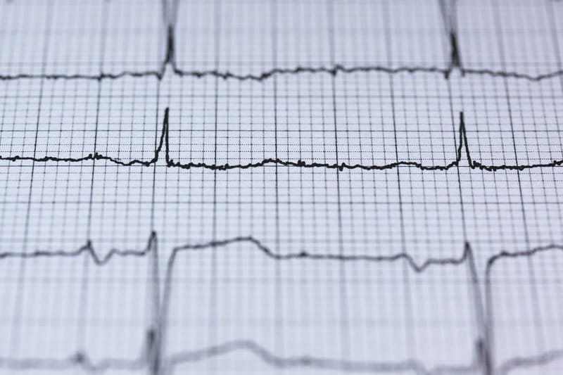 TeleHealth UseCase: Remote ECG dataset monitoring