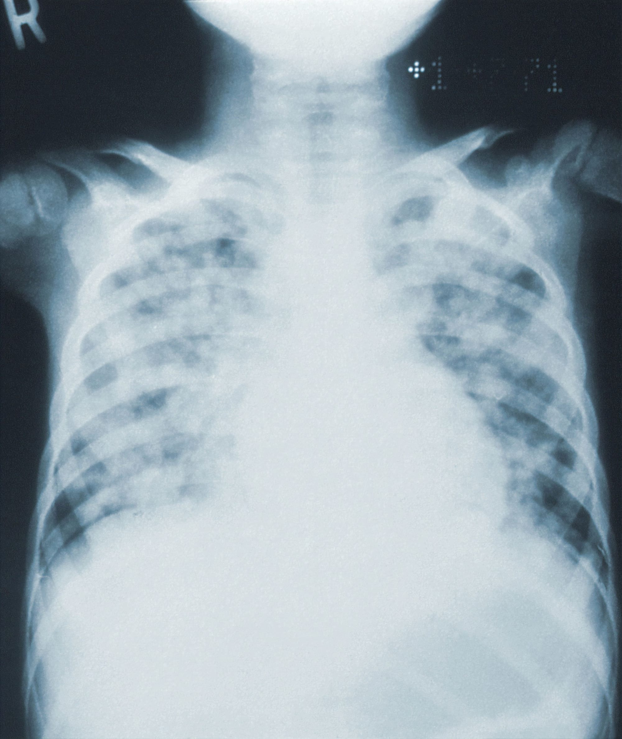 Breath tests for lung infections