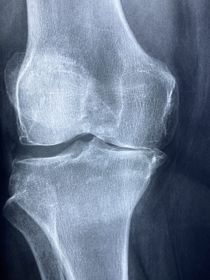 Arthritis: Natural remedial support