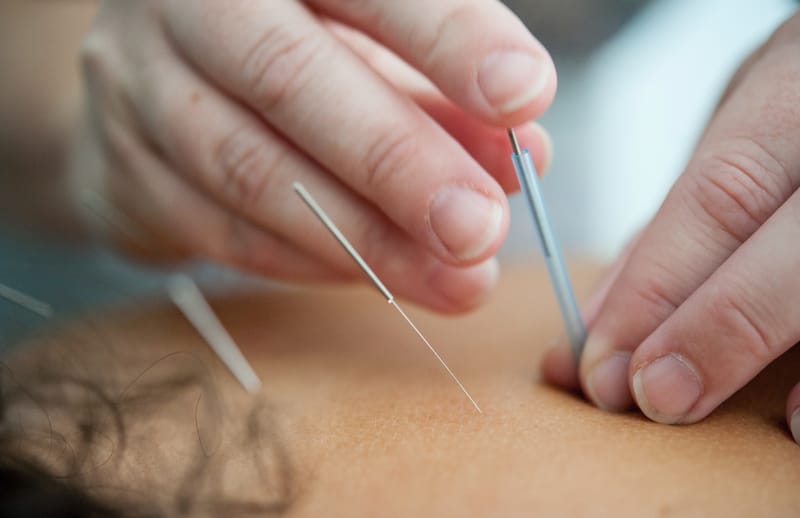 Medical Acupuncture