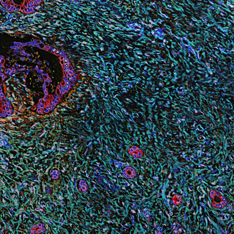 Enhanced Immune Infiltration in Prostate Cancer Through Combined Anti-PD-1 Immunotherapy and Androgen Deprivation Therapy