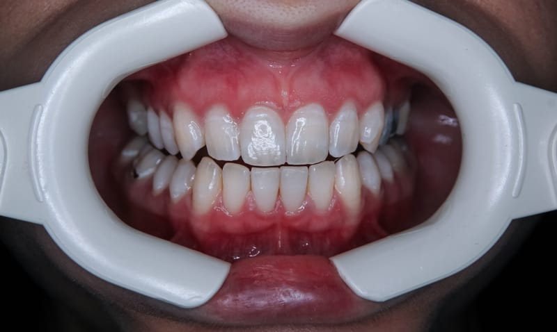 Tooth Whitening Procedure