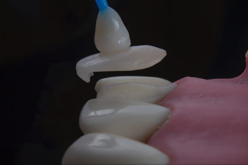 carillas de porcelana