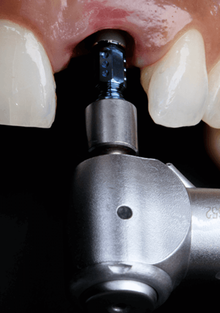 Implantes Dentários