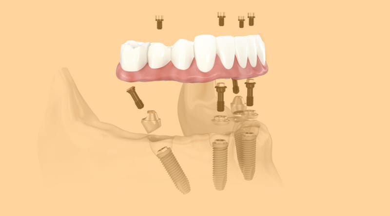 Dentadura fixa ou móvel? Entenda e compare as principais diferenças.
