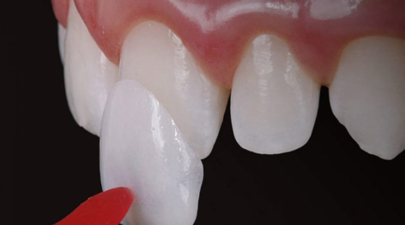 Lente de contato dental: durabilidade é longa mas exige cuidados.
