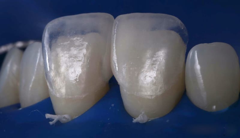 Faceta de porcelana é segura, mas desgastes nos dentes exigem atenção.