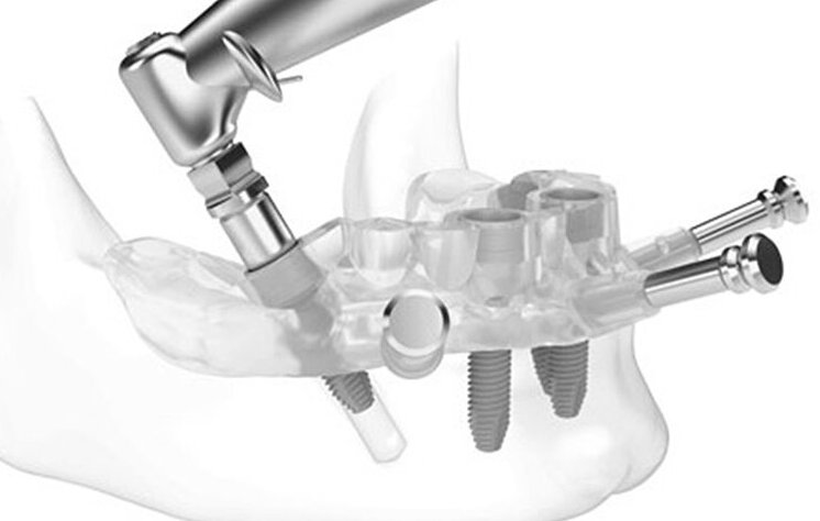 Cirurgia sem cortes para implante dentário: conheça a técnica.
