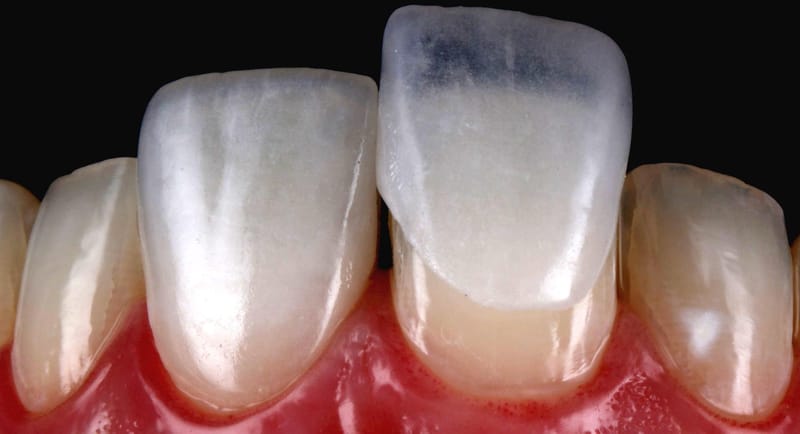 Lentes de Contato Dental