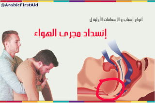 إنسداد مجرى الهواء (المسالك التنفسية):أنواعه, أسبابه و كيف نسعفه