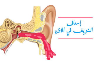 أسباب النزيف من الاذن و إسعافه