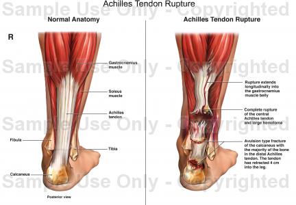 achilles tendon