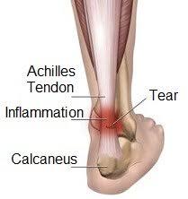 achilles tendonitis