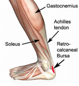 heel (retrocalcaneal bursitis)