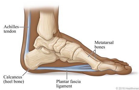 plantar fasciitis