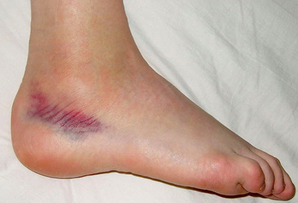 ankle sprain