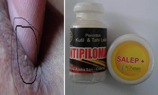 2 Salep Tanpa Kambuh Obat Kutil Kelamin Penetesan
