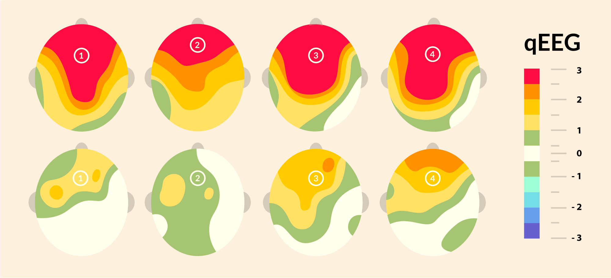 Do I need a brain map when starting neurofeedback?