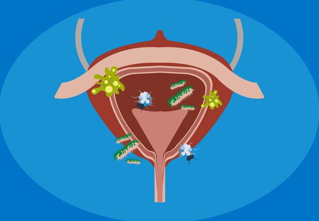5 Things Your Need to Avoid When You Have UTI