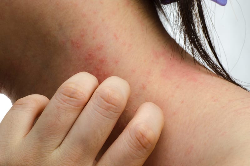 Natural Remedies to Help Relieve Your Eczema