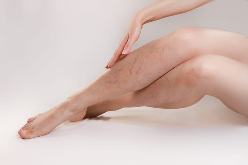 Things You Need To Know About Varicose Veins And DVT