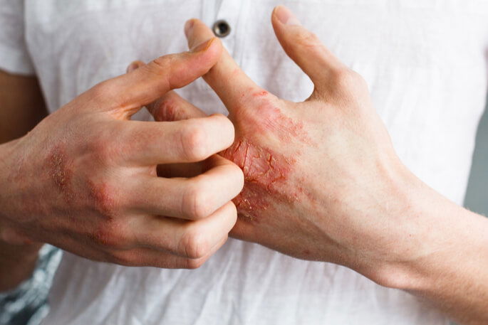 Brief Guide In Controlling Your Eczema Condition