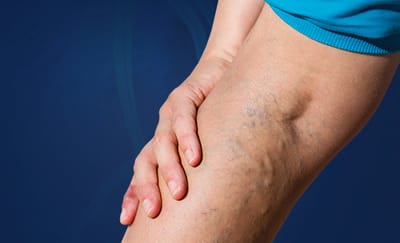Everything You Need to Know About Varicose and Spider Veins