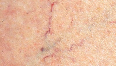 Spider Veins: Treatment and Prevention