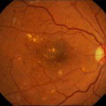 Fundus Fluorescein Angiogram Photographs of Diabetic Patients