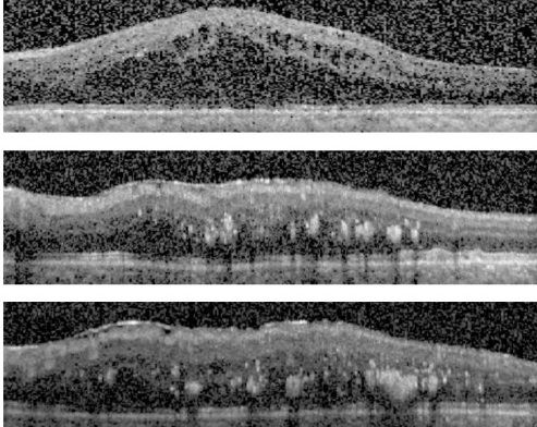 Dataset for OCT Classification (50 Normal, 48 AMD & 50 DME)