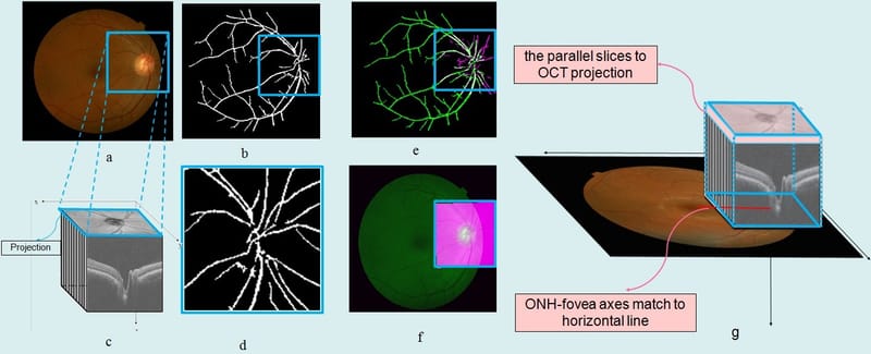 ONH-based OCT of 7 healthy and 7 glaucoma data captured by Heidelberg Spectralis