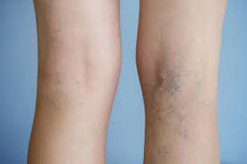 5 Minimally-Invasive Varicose Vein Treatment Aftercare Tips