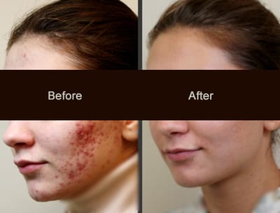 Best Treatment For Acne Scars