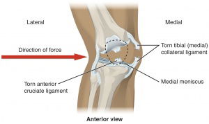 medial collateral ligament