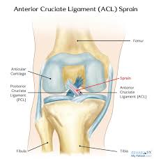 ACL SPRAIN