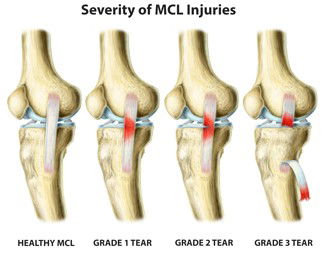 MCL sprain