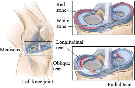 meniscus injuries