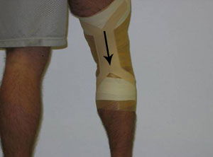 knee hyperextension