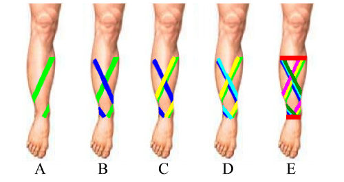 shin splint