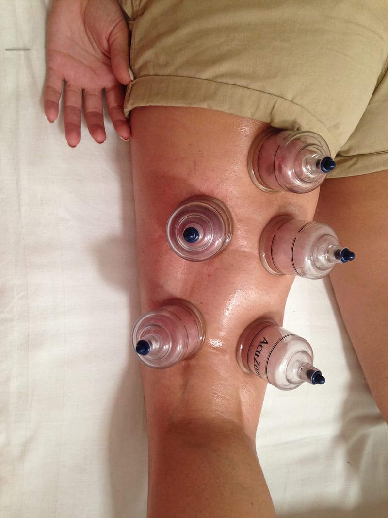 Cupping