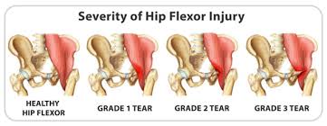 hip flexor strain