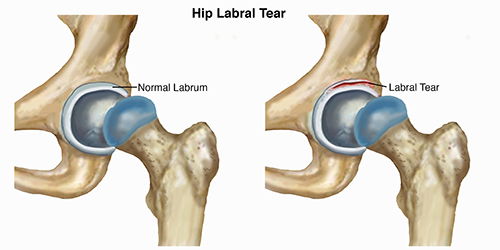 labral tear