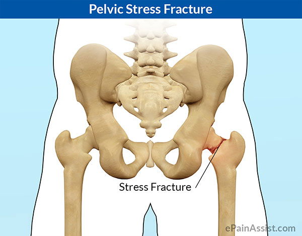 pelvic stress fracture